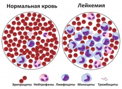 Лейкемия – причины, симптомы, лечение и профилактика