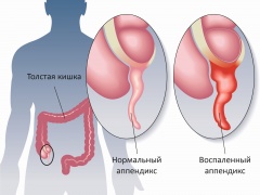 Аппендицит - причины, симптомы, лечение и профилактика