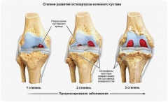 Остеоартроз(остеоартрит): Факторы риска, типы остеоартрита