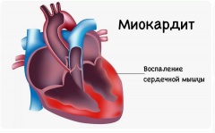 Воспаления миокарда - причины, симптомы, лечение и профилактика