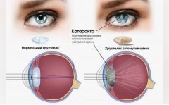Катаракта – причины, симптомы, лечение и профилактика